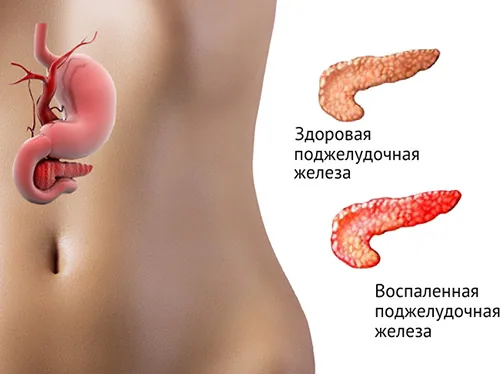 В чем выражаются признаки панкреатита