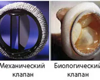 Создана новая модель клапана сердца