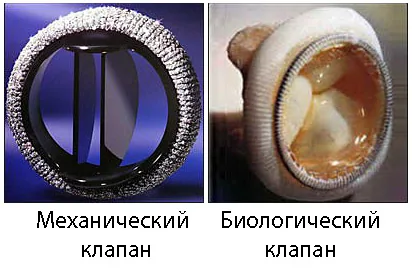 Создана новая модель клапана сердца