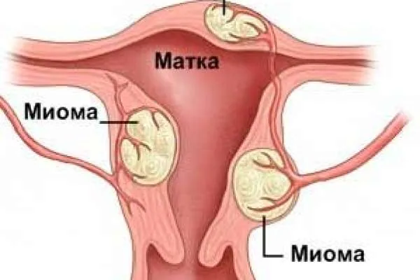 Лечение миомы матки без операций