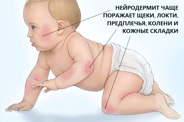 Нейродермит у детей: симптомы и лечение