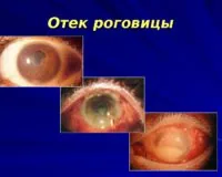 Почему происходит отек роговицы?