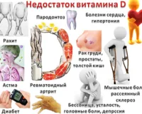 Дефицит витамина D: симптомы и лечение