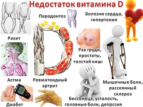 Дефицит витамина D: симптомы и лечение