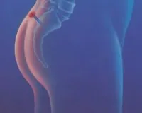 Иссечение копчиковой кисты