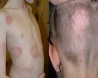 Лишай у людей: симптомы