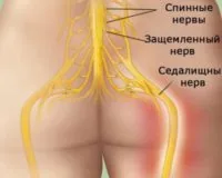 Защемление нерва: первая помощь