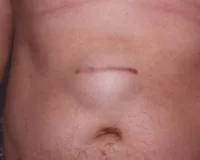 Пластика пупочной грыжи белой линии живота