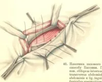 Пластика пахового канала при  паховой грыже