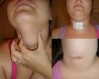 Лобэктомия: хирургический метод лечения заболеваний щитовидки