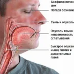 Оказание помощи при анафилактическом шоке