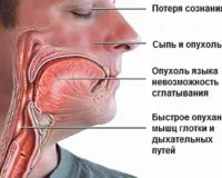 Оказание помощи при анафилактическом шоке