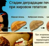 Что такое жировой гепатоз печени?
