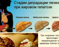 Что такое жировой гепатоз печени?