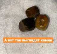 Камни в мочеточнике: удаление хирургическим путем
