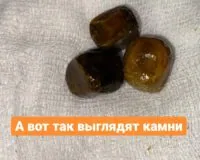 Камни в мочеточнике: удаление хирургическим путем