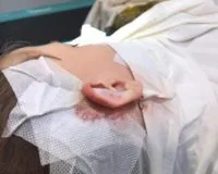 С какого возраста можно делать отопластику и ринопластику