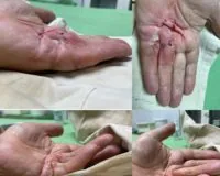 Контрактура Дюпюитрена: хирургическое лечение